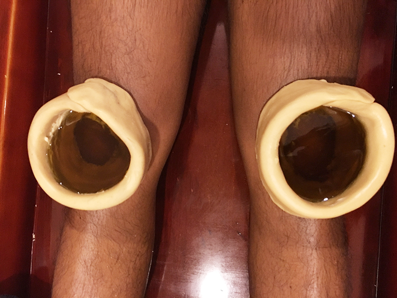 Januvasti Ayurvedic Knee Pain Treatment